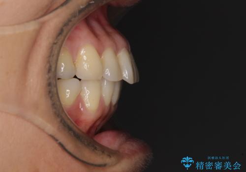 痛む奥歯と矯正の後戻り インビザライン・ライトとセラミック治療の治療前