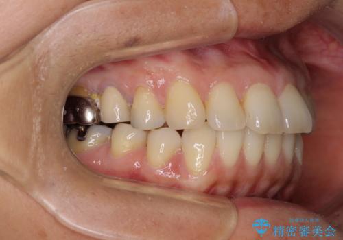 痛む奥歯と矯正の後戻り インビザライン・ライトとセラミック治療の治療前