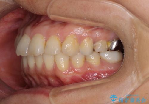 痛む奥歯と矯正の後戻り インビザライン・ライトとセラミック治療の治療前