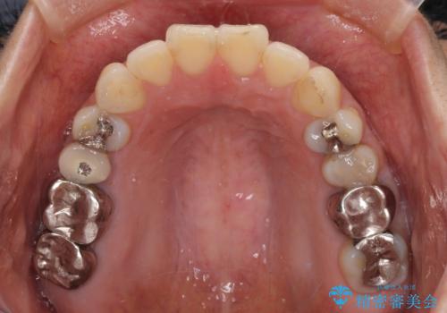 痛む奥歯と矯正の後戻り インビザライン・ライトとセラミック治療の治療前