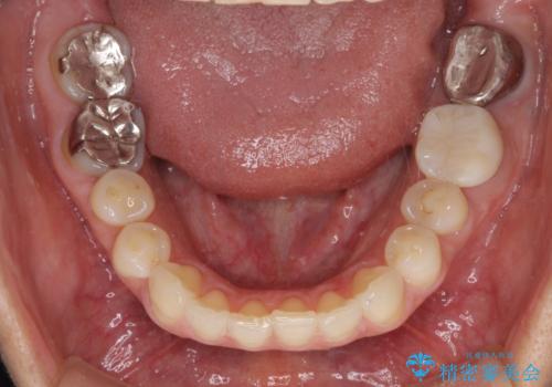 痛む奥歯と矯正の後戻り インビザライン・ライトとセラミック治療の治療前