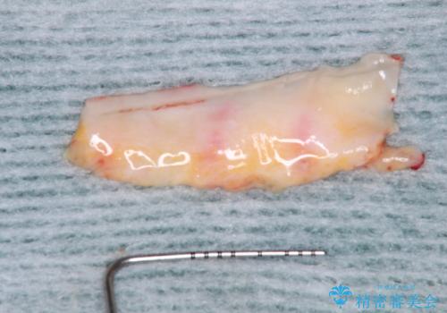 下顎前歯の歯肉退縮 歯肉移植による根面被覆の治療中