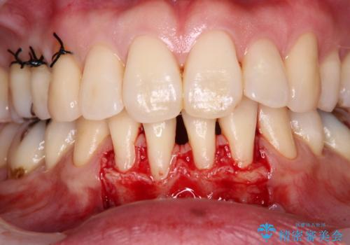 下顎前歯の歯肉退縮 歯肉移植による根面被覆の治療中