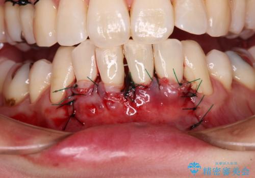 下顎前歯の歯肉退縮 歯肉移植による根面被覆の治療中