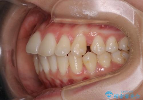非抜歯でも劇的変化　インビザライン矯正治療の治療中
