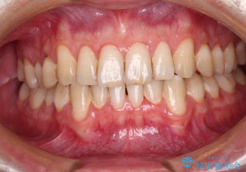 しみてしまう下顎の犬歯　歯肉移植による根面被覆の治療前