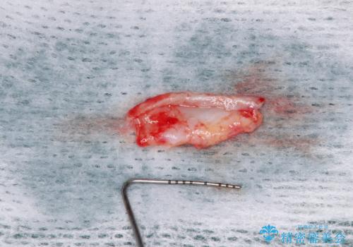 しみてしまう下顎の犬歯 歯肉移植による根面被覆の治療中