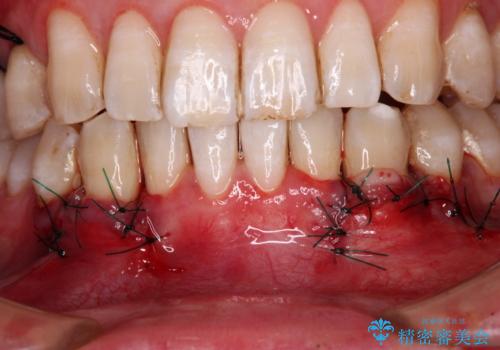 しみてしまう下顎の犬歯 歯肉移植による根面被覆の治療中