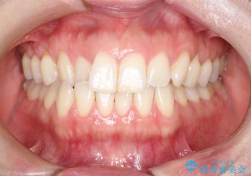 上の歯と下の歯が反対にかんでいる インビザラインによる目立たない矯正の症例 治療前