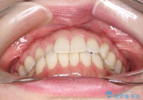 上の歯と下の歯が反対にかんでいる インビザラインによる目立たない矯正の治療前