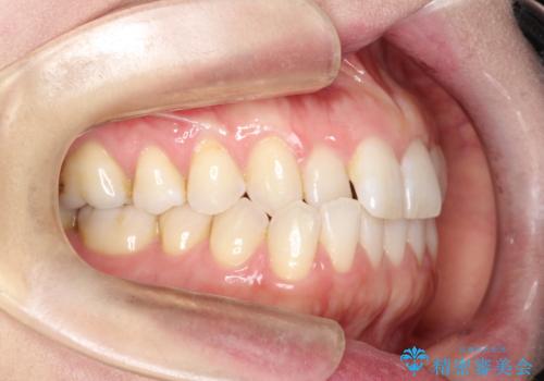 上の歯と下の歯が反対にかんでいる インビザラインによる目立たない矯正の治療前