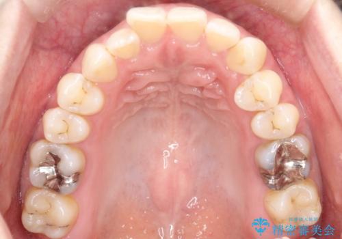 上の歯と下の歯が反対にかんでいる インビザラインによる目立たない矯正の治療前