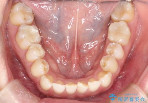 上の歯と下の歯が反対にかんでいる インビザラインによる目立たない矯正の治療前