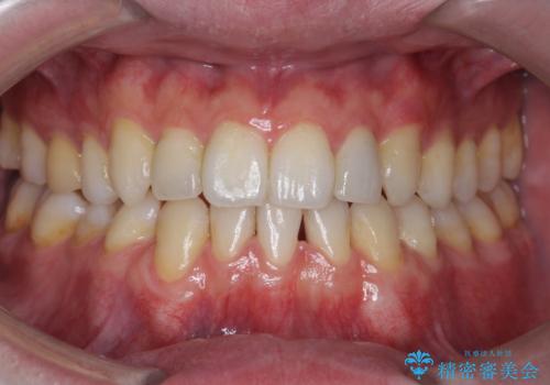 前歯の矮小歯　奥歯の反対咬合　をインビザラインでの治療後