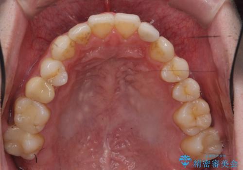 前歯の矮小歯 奥歯の反対咬合 をインビザラインでの治療後