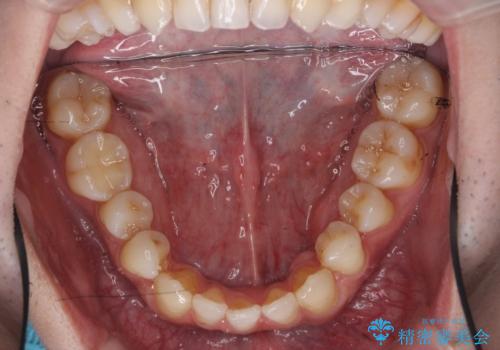 前歯の矮小歯 奥歯の反対咬合 をインビザラインでの治療後