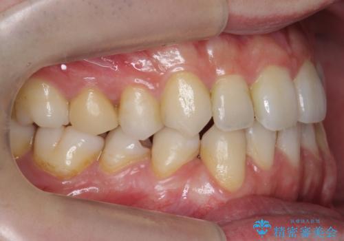 前歯の矮小歯 奥歯の反対咬合 をインビザラインでの治療後