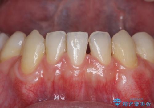 歯茎の下がりが気になる 歯肉移植でさがりにくくするの治療後