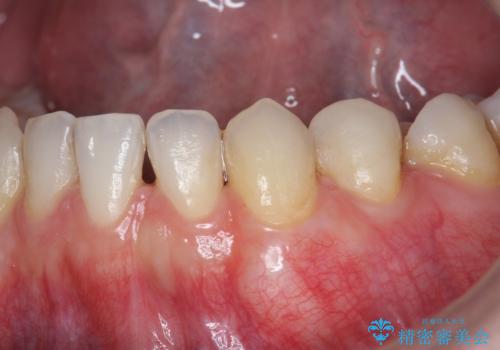 歯茎の下がりが気になる 歯肉移植でさがりにくくするの症例 治療後