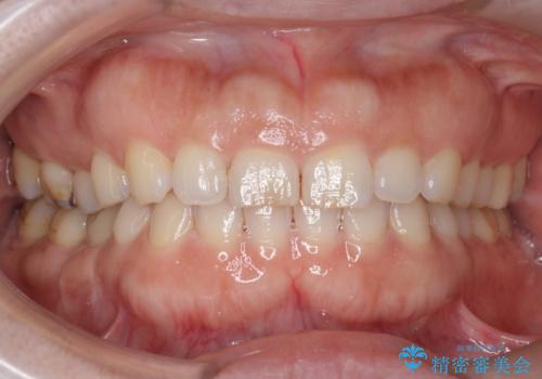 オフィスホワイトニングで、明るく白い歯に!の治療前