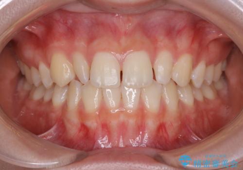 部分矯正とセラミッククラウンですきっ歯・矮小歯を効率的に治すの症例 治療前