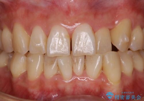 インビザラインの矯正中のクリーニングの治療前