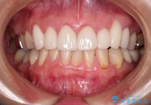 歯磨きの度にしみる歯　露出した歯根を歯肉移植で改善の治療前