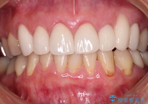 歯磨きの度にしみる歯 露出した歯根を歯肉移植で改善の治療前