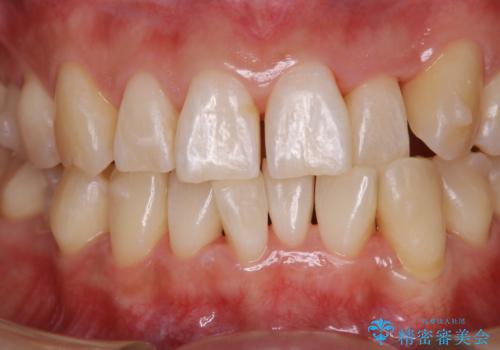 インビザラインの矯正中のクリーニングの治療後