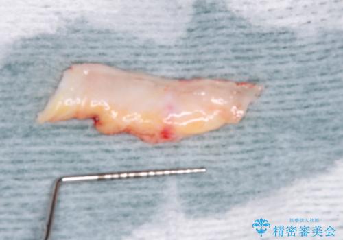 歯磨きの度にしみる歯 露出した歯根を歯肉移植で改善の治療中