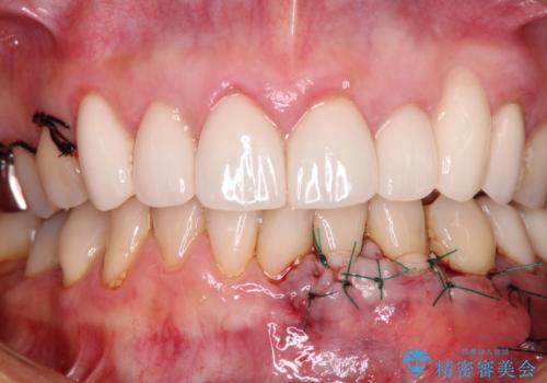 歯磨きの度にしみる歯 露出した歯根を歯肉移植で改善の治療中