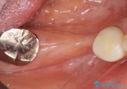 骨が薄く他院でインプラントできないと言われた 50代女性の治療前