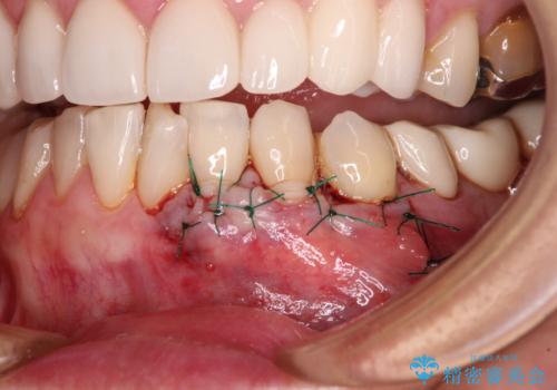 歯磨きの度にしみる歯 露出した歯根を歯肉移植で改善の治療中