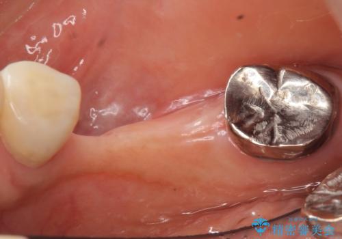骨が薄く他院でインプラントできないと言われた 50代女性の治療前