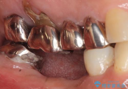 骨が薄く他院でインプラントできないと言われた 50代女性の治療前