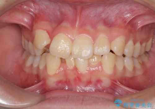 八重歯で正中が右にずれている ワイヤー装置での抜歯矯正で正中位置を改善の症例 治療前