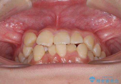 八重歯で正中が右にずれている　ワイヤー装置での抜歯矯正で正中位置を改善の治療前