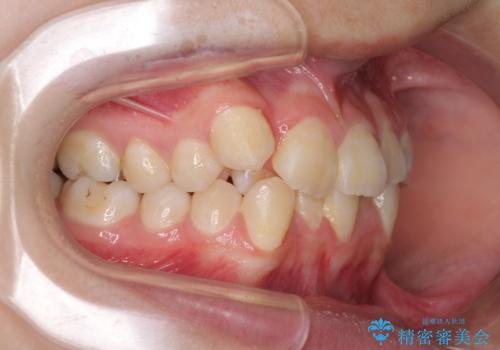 八重歯で正中が右にずれている ワイヤー装置での抜歯矯正で正中位置を改善の治療前