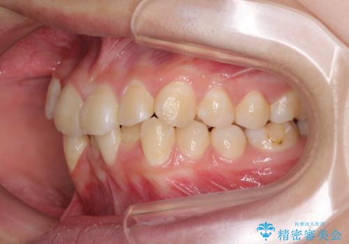 八重歯で正中が右にずれている ワイヤー装置での抜歯矯正で正中位置を改善の治療前