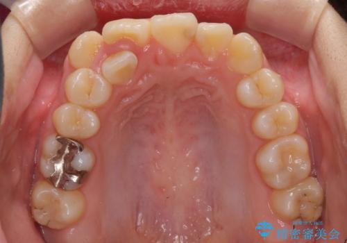 八重歯で正中が右にずれている ワイヤー装置での抜歯矯正で正中位置を改善の治療前