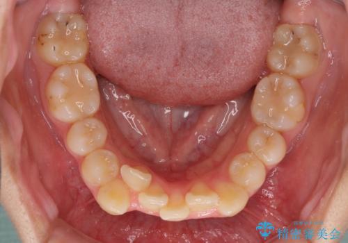 八重歯で正中が右にずれている ワイヤー装置での抜歯矯正で正中位置を改善の治療前