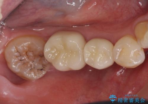 詰め物の下が虫歯 つぎはぎの歯をしっかり治療の治療後
