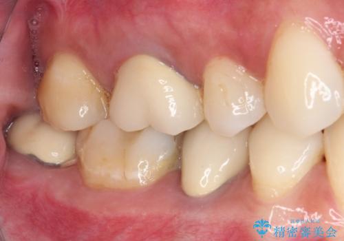 奥歯がしみる 色々な国で治療を受けてきた奥歯のむし歯治療の治療前