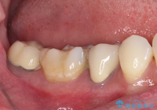 奥歯がしみる 色々な国で治療を受けてきた奥歯のむし歯治療の治療前