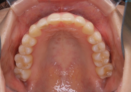 非抜歯でも劇的変化　インビザライン矯正治療の治療後