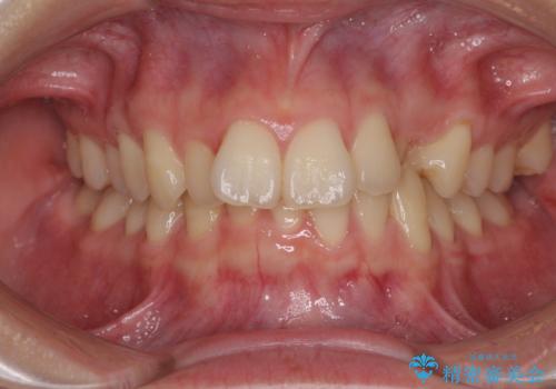 【モニター】犬歯のクロスバイトを目立たないワイヤー装置での治療前