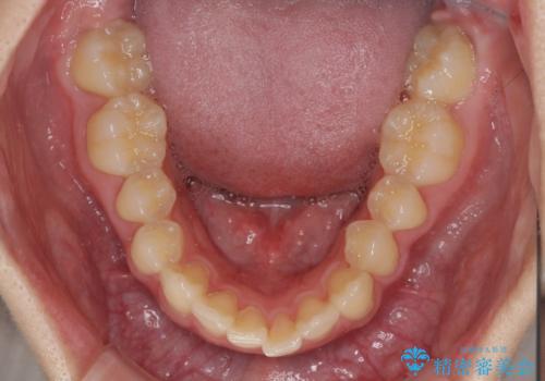 【モニター】犬歯のクロスバイトを目立たないワイヤー装置での治療前