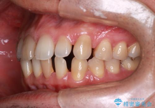 【前歯の隙間】インビザラインですきっ歯の矯正治療の治療前