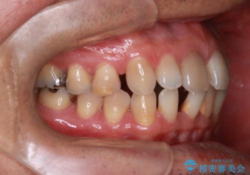 【前歯の隙間】インビザラインですきっ歯の矯正治療の治療前