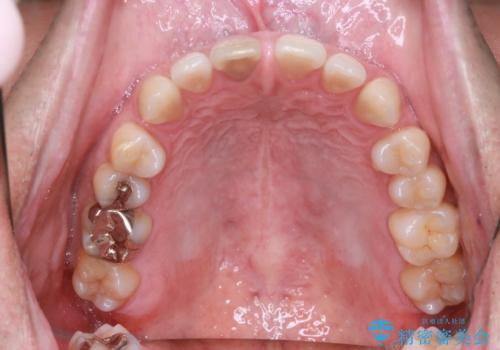 【前歯の隙間】インビザラインですきっ歯の矯正治療の治療前